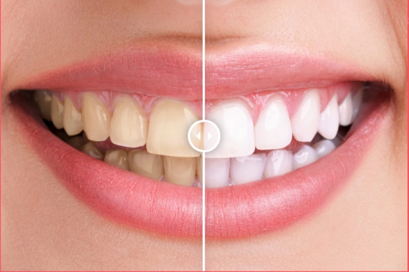 Teeth Whitening